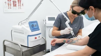Láser Pico vs. Eliminación Tradicional de Tatuajes: Una Comparación Basada en Datos