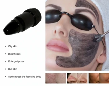 How Carbon Peeling with Q-Switched ND YAG Laser Works for All Skin Types