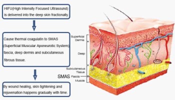 HIFU Ablation vs. Traditional Tumor Treatments: A Data-Driven Guide for Patients