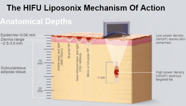 HIFU vs. Surgery: How to Choose the Right Anti-Aging Treatment for You