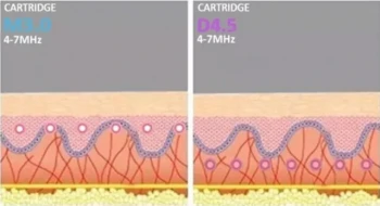 Why HIFU Outperforms Other Non-Surgical Treatments for Lasting Facial Rejuvenation