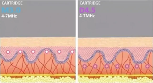 Почему HIFU превосходит другие нехирургические процедуры для длительного омоложения лица