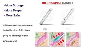 HIFU Vaginal Tightening: Science, Safety, and How It Stacks Up Against Alternatives
