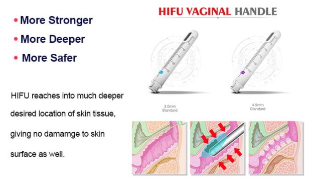 HIFU Vaginal Tightening: Science, Safety, and How It Stacks Up Against Alternatives