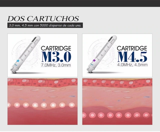 ¿Cuántas sesiones de HIFU para el estiramiento vaginal? Recomendaciones con base científica