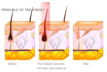 How SHR Laser Hair Removal Works: The Science Behind Multiple Sessions