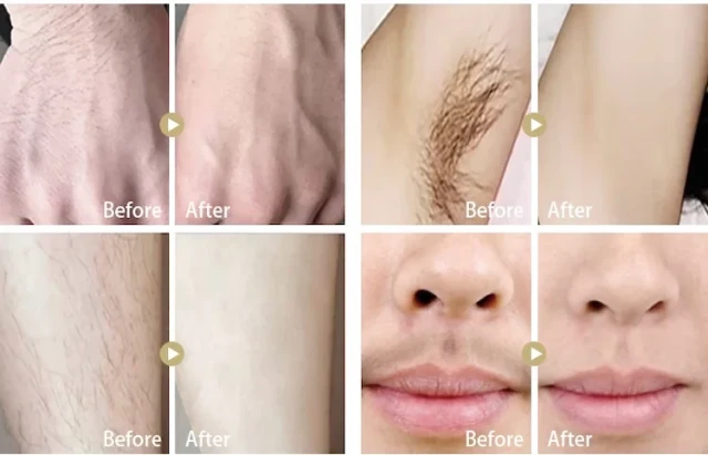 IPLテクノロジーは、脱毛にとどまらず、さまざまな肌状態をどのように治療するのか