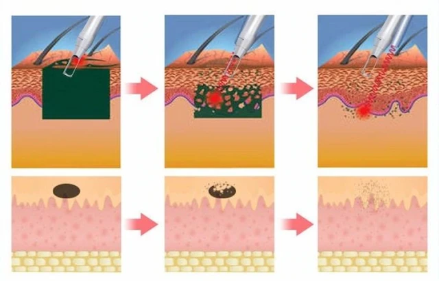 Wie der Pico-Laser sicherere und schnellere Hautbehandlungen ermöglicht: Evidenz-basierte Einblicke
