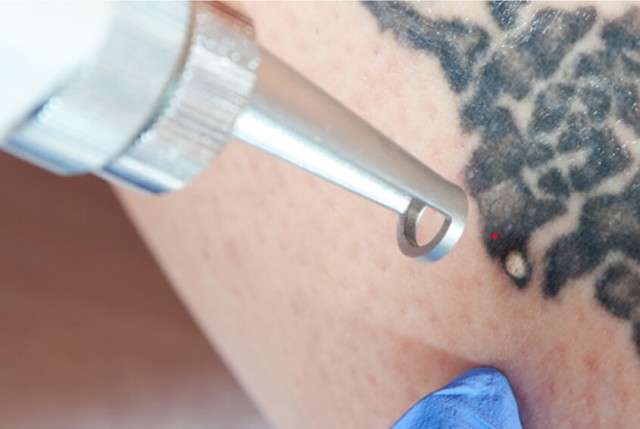 Pico Laser vs. Traditional Tattoo Removal: Which Method Delivers Better Results?