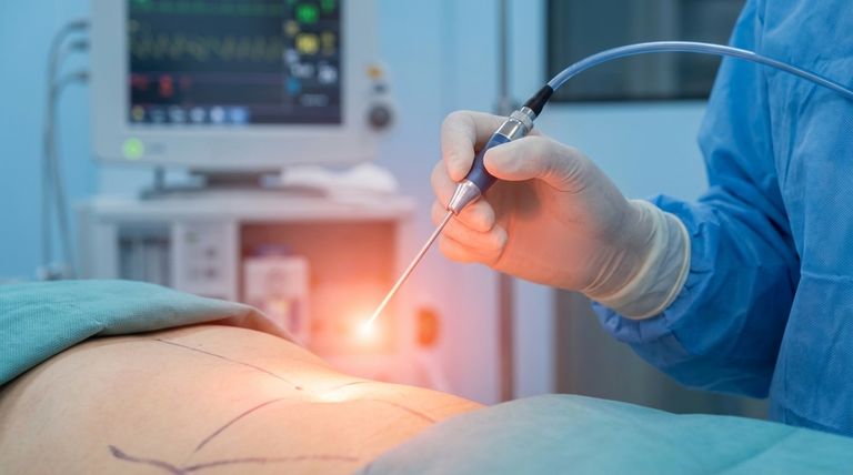 ¿Cuáles son las desventajas de la liposucción láser? Riesgos clave y limitaciones quirúrgicas